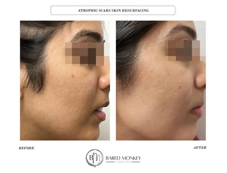 Skin rejuvenation result 6