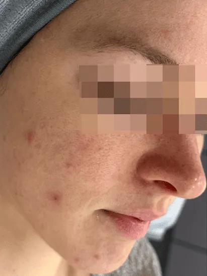 Before skin flushing treatment