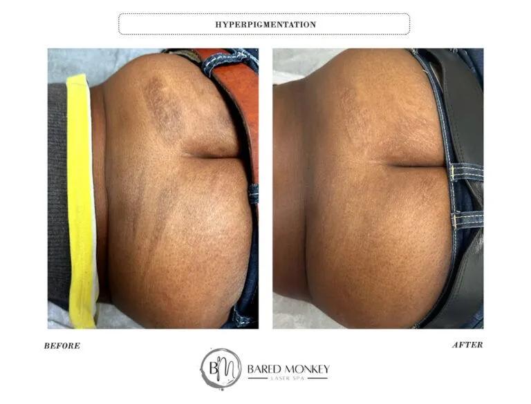 Skin rejuvenation result 32