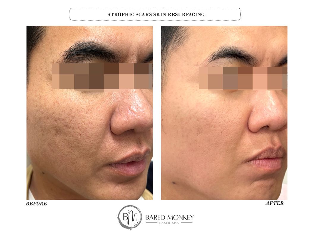 Microneedling result 4
