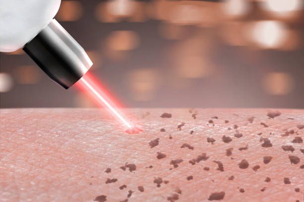Laser-Pigmentation-Removal