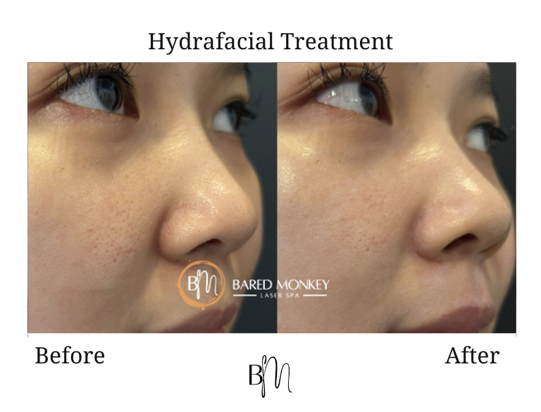 Hydrafacial result 1