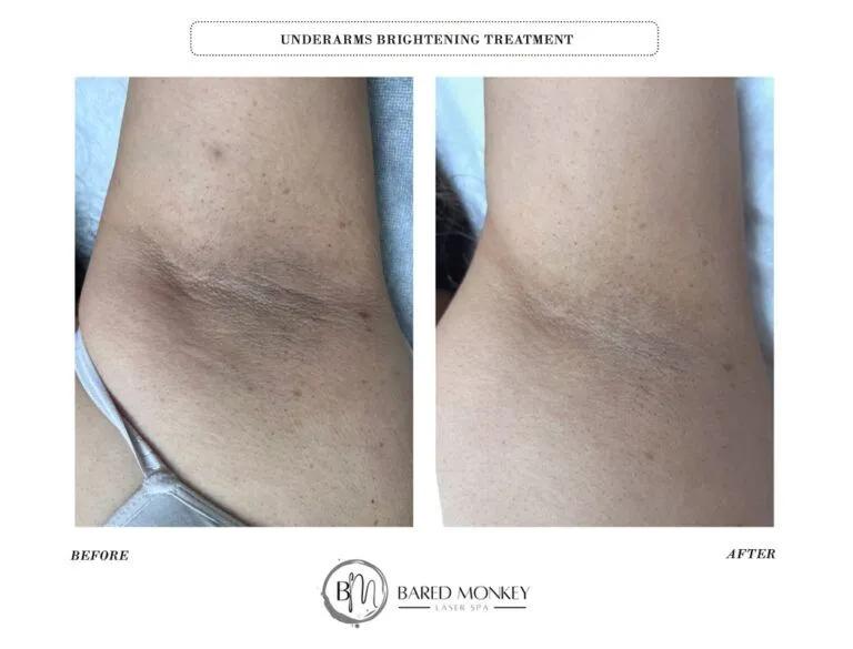 Skin rejuvenation result 46