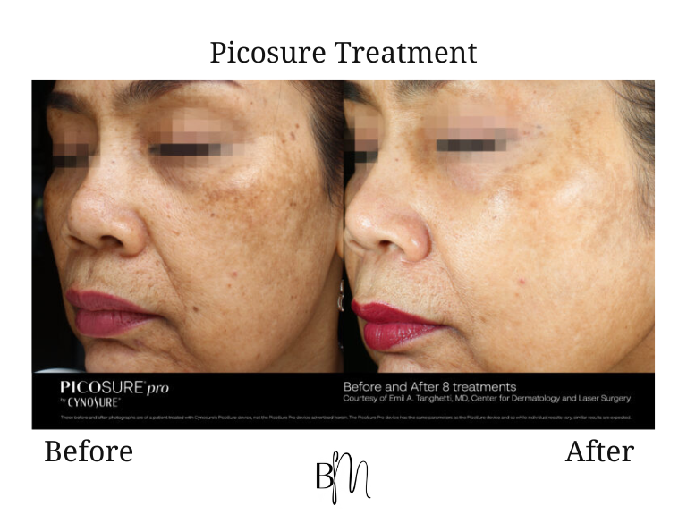 Picosure treatment result 7