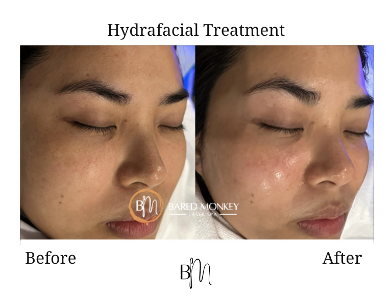 Hydrafacial result 2