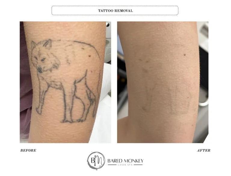 Tattoo removal result 7