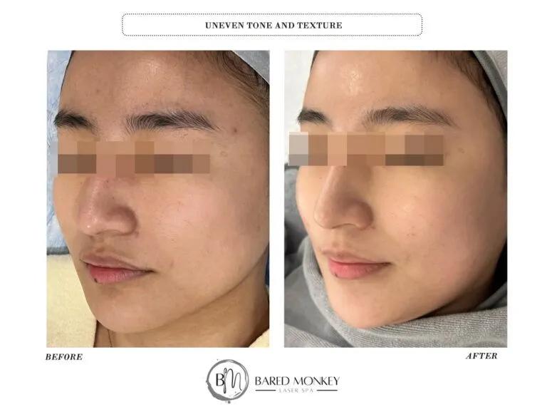 Skin rejuvenation result 47