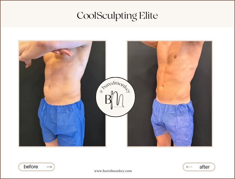 CoolSculpting® Elite
