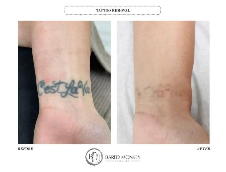 Tattoo removal result 3