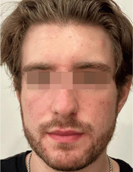 After AviClear skin clarity