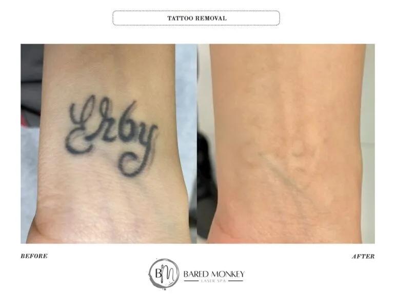 Tattoo removal result 14