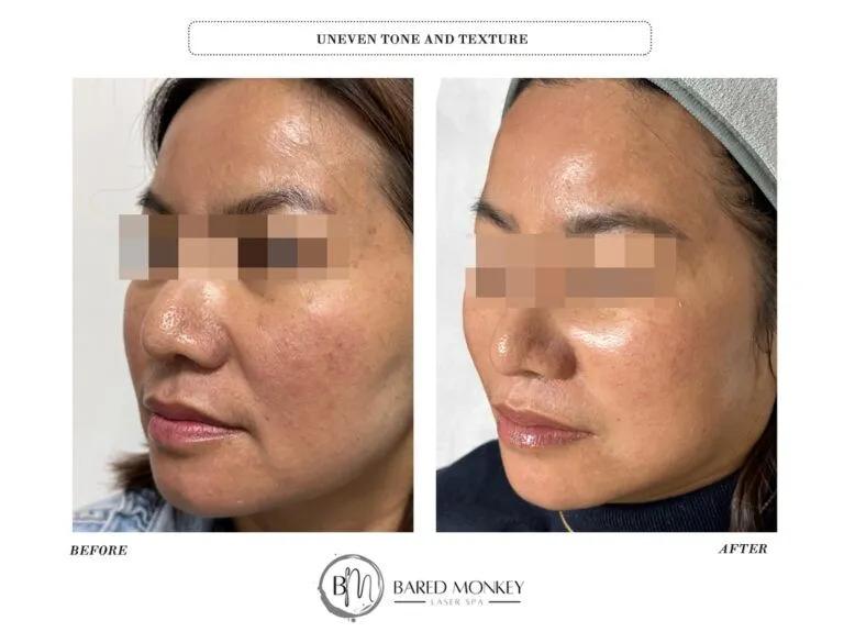 Skin rejuvenation result 48