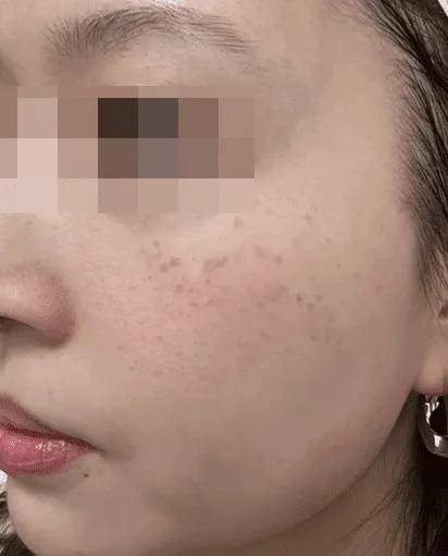 Before UV-induced hyperpigmentation treatment
