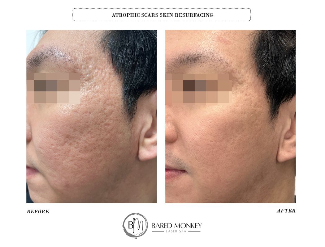 Microneedling result 9