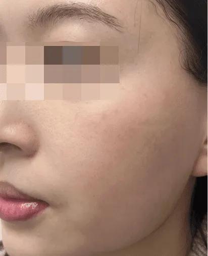 After UV-induced hyperpigmentation treatment