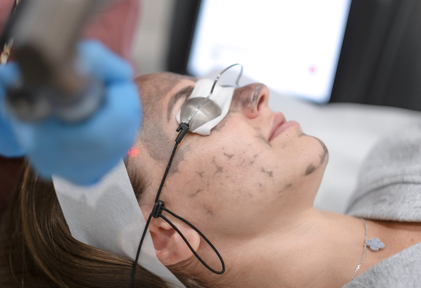 Hollywood Spectra treatment in progress