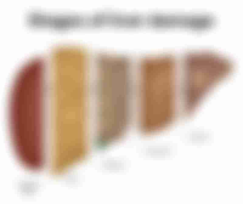 Illustration of the progression of liver disease from fatty liver to cancer