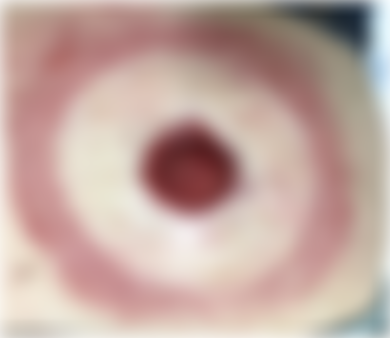 Peristomal Dermatitis