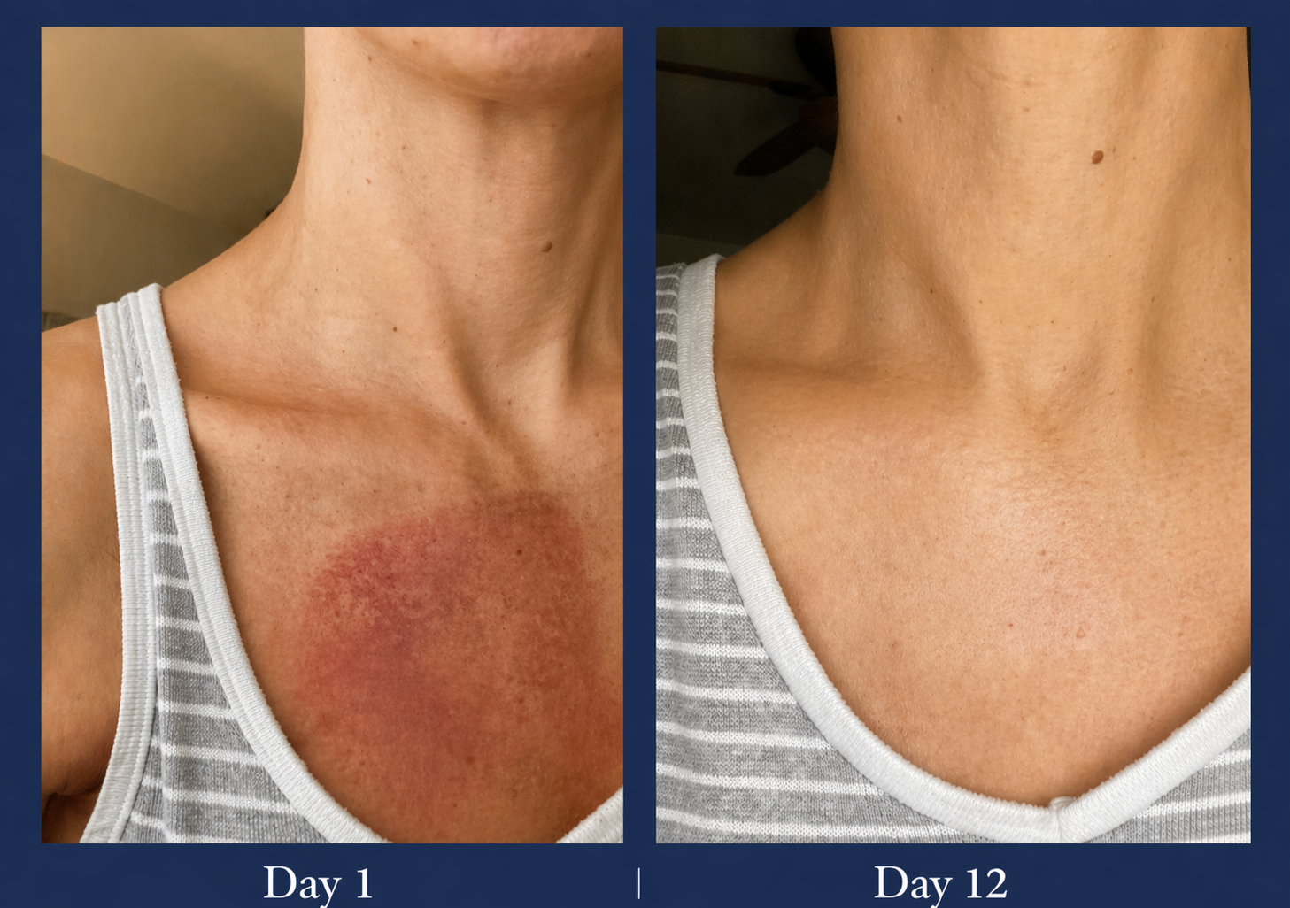 radiation burns