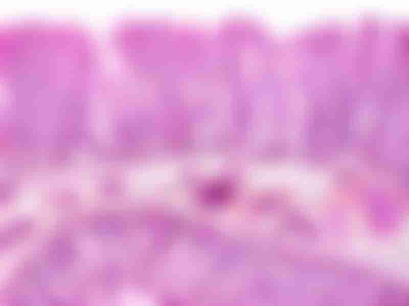Sessile Serrated Polyps