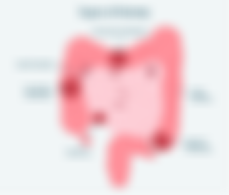 Types of Ostomy