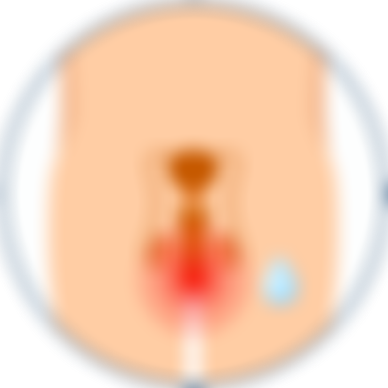Prostate Cancer Painful Burning Urination