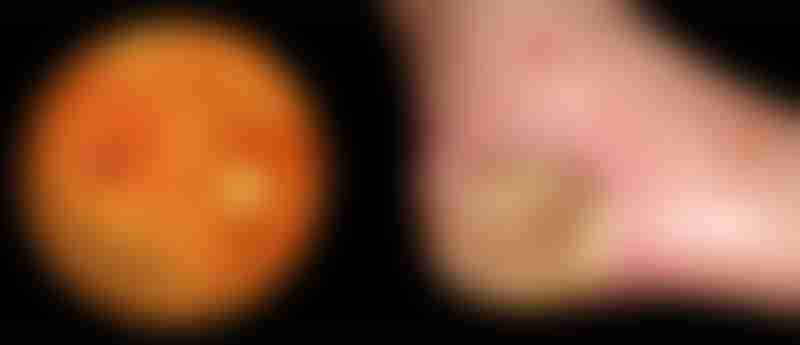 Diabetic Retinal Damage and Foot Ulcer
