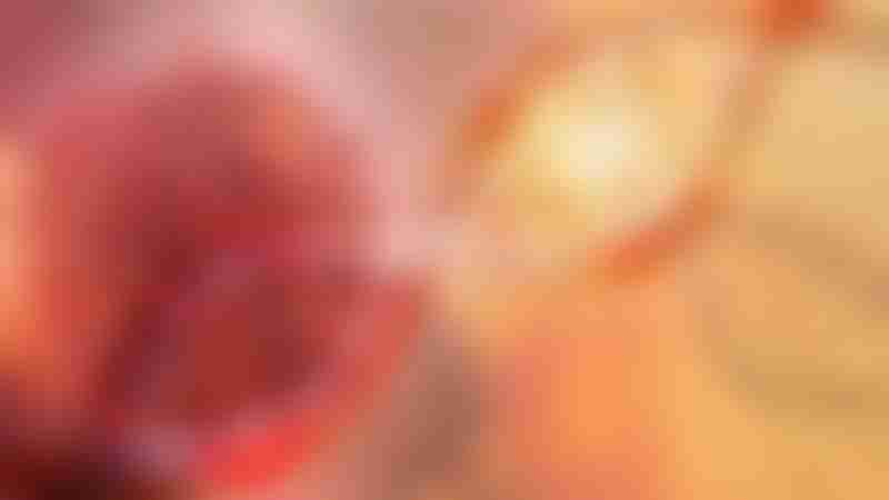 Hereditary Diffuse Gastric Cancer