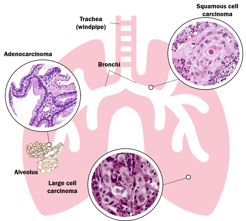 NSCLC Subtypes