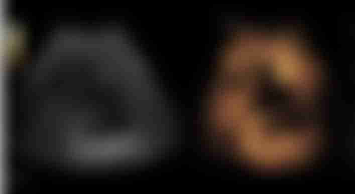 Ultrasound for liver cancer diagnosis