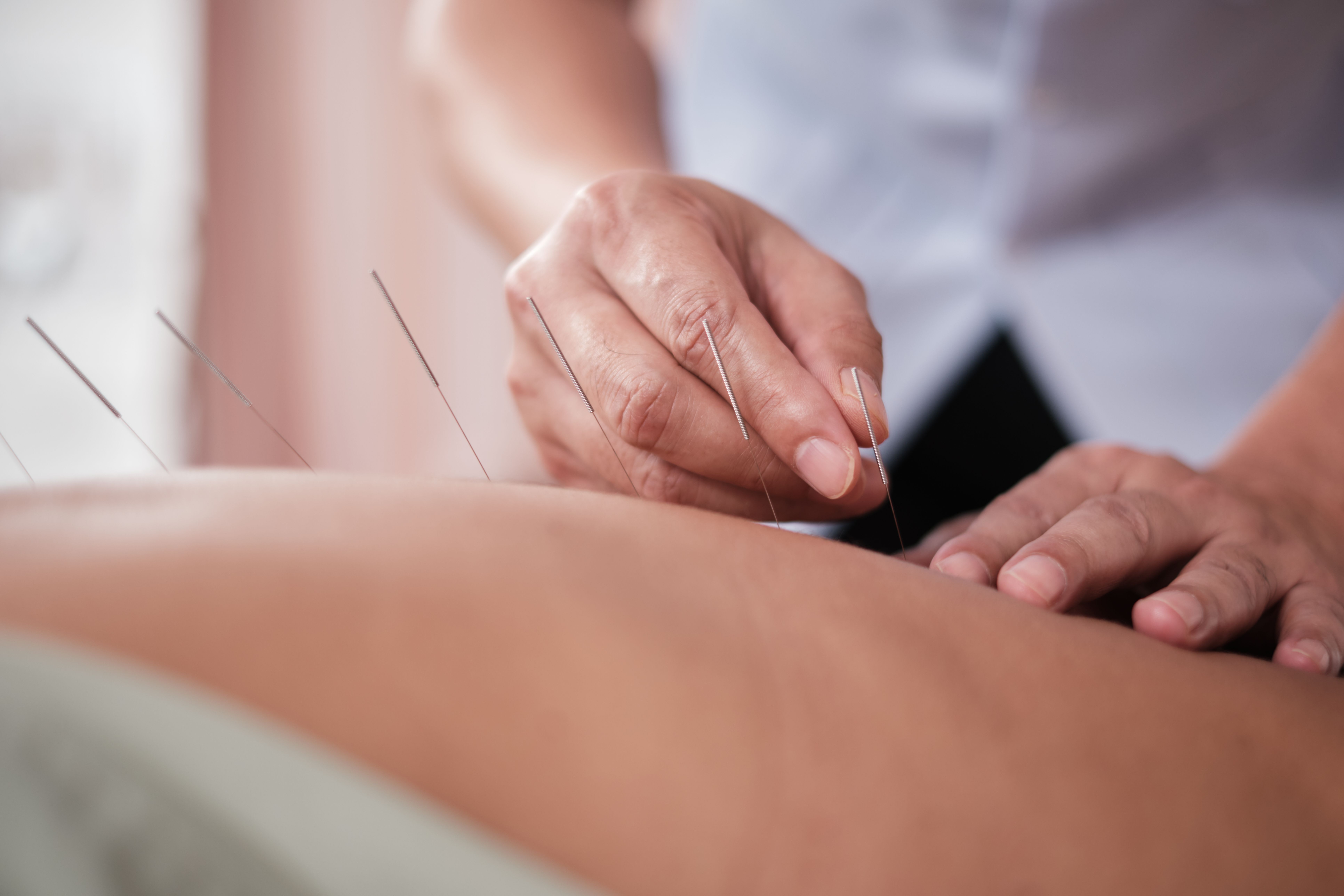 Asian physiotherapist treats patient's back muscle pain relief by acupuncture