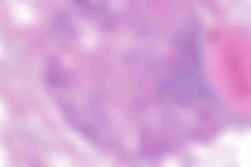Lung Carcinoid Tumourlet Histology Slide