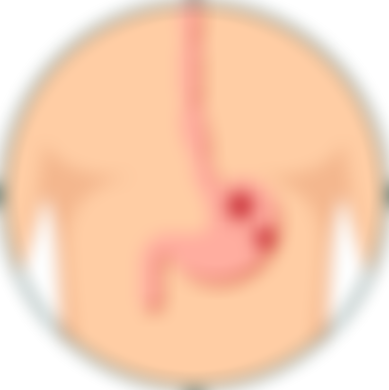Gastric Cancer Stomach Pain