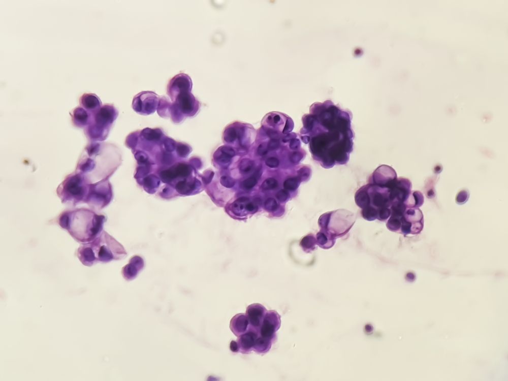 cancer image