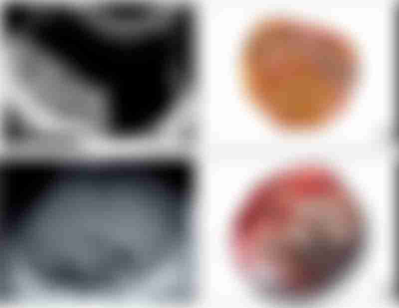 Ultrasound Macroscopic Images Gynecologic Cancer