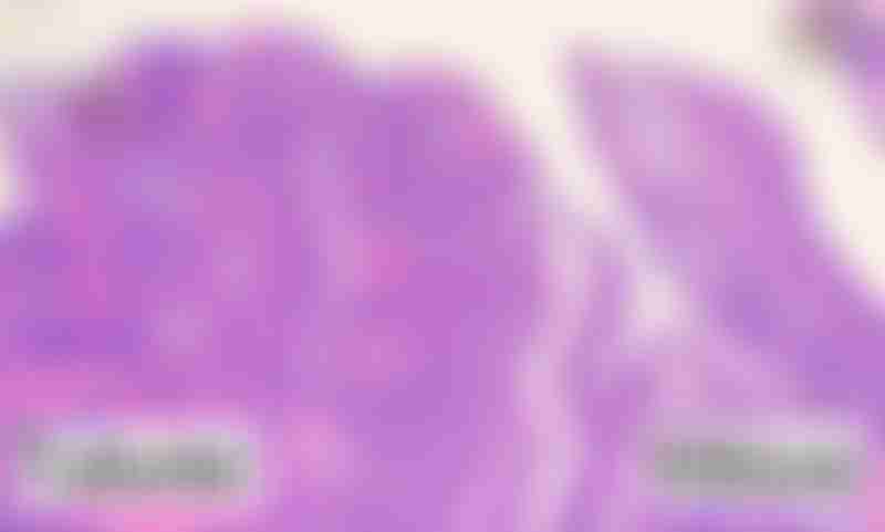 Tubular vs Villous Tumor Growth