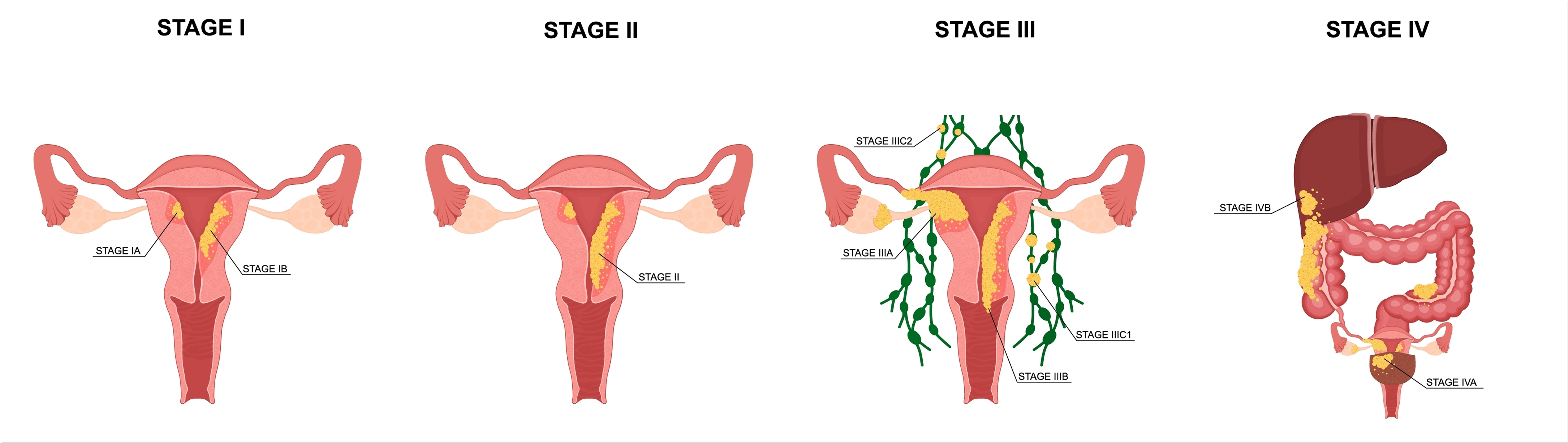 Endometrial cancer stages