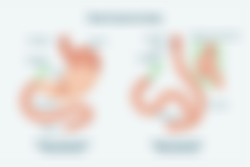 Total Gastrectomy