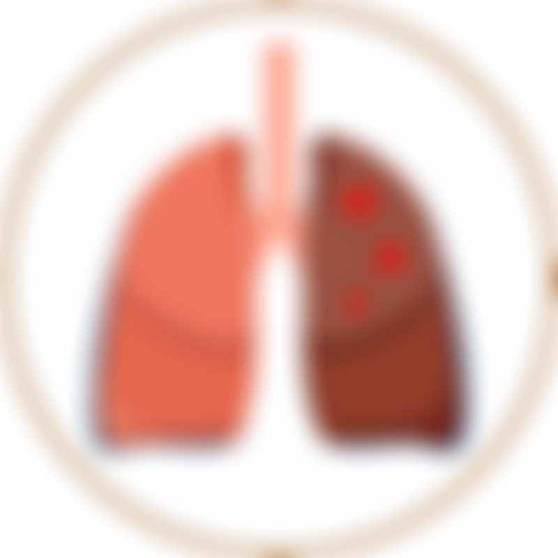 Lung Cancer Repeated Lung Infection