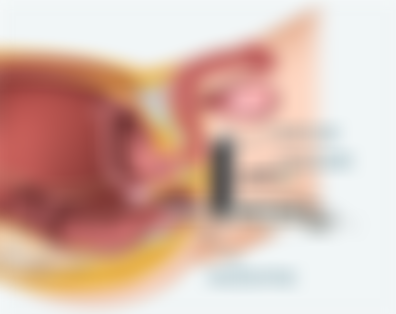 Transperineal Prostate Biopsy