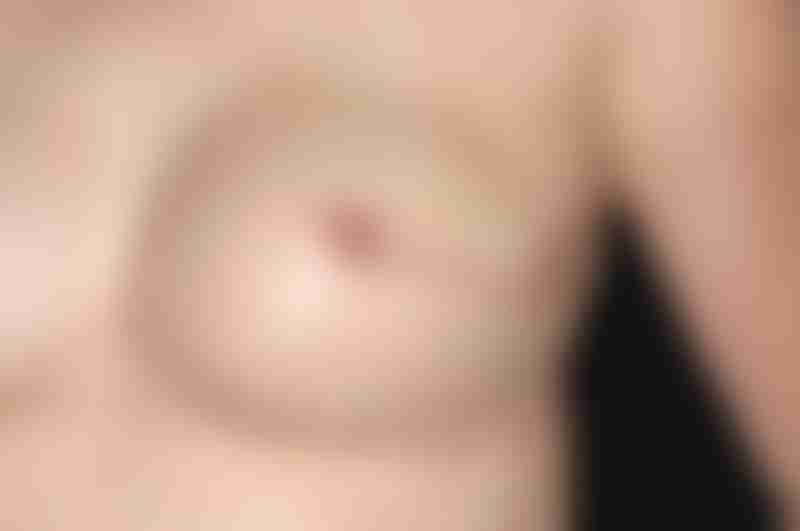 Breast Surgery Scar