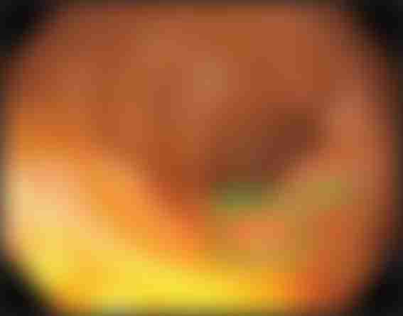 CADE Polyp Detection