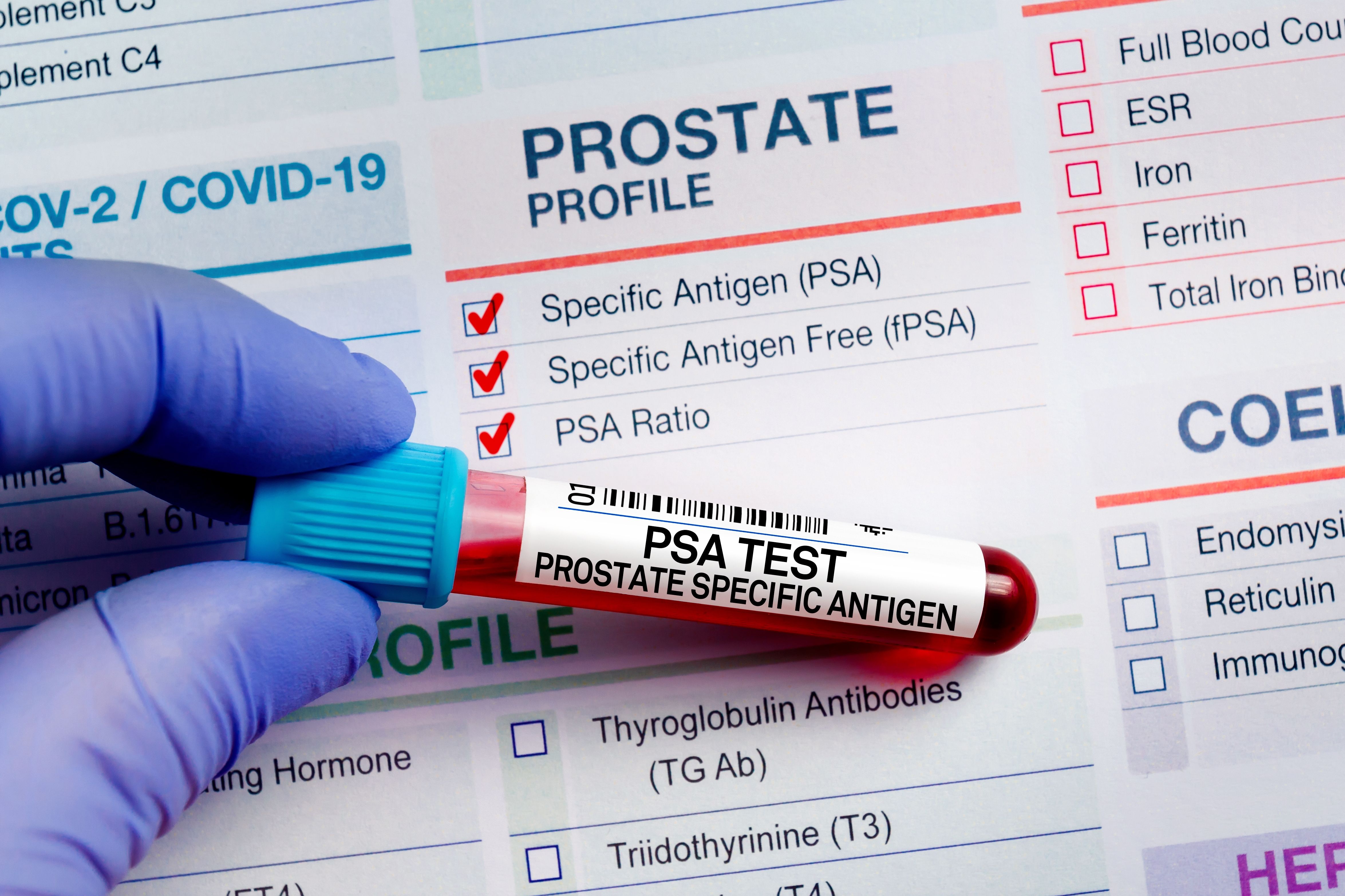 PSA: Prostate Cancer Test