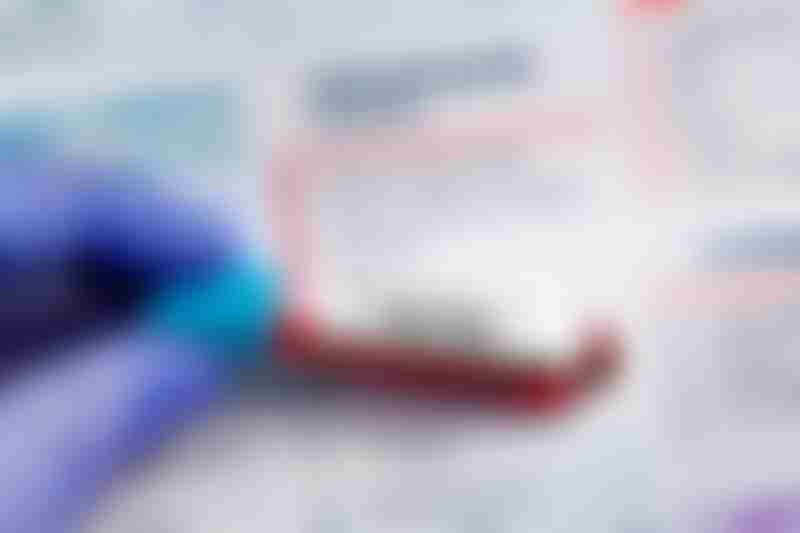 PSA Test Prostate Cancer