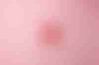 Fertility Prostate Cancer Treatment