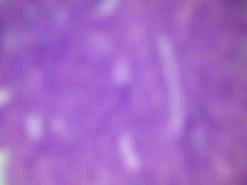 Tubular Adenoma High Grade Dysplasia