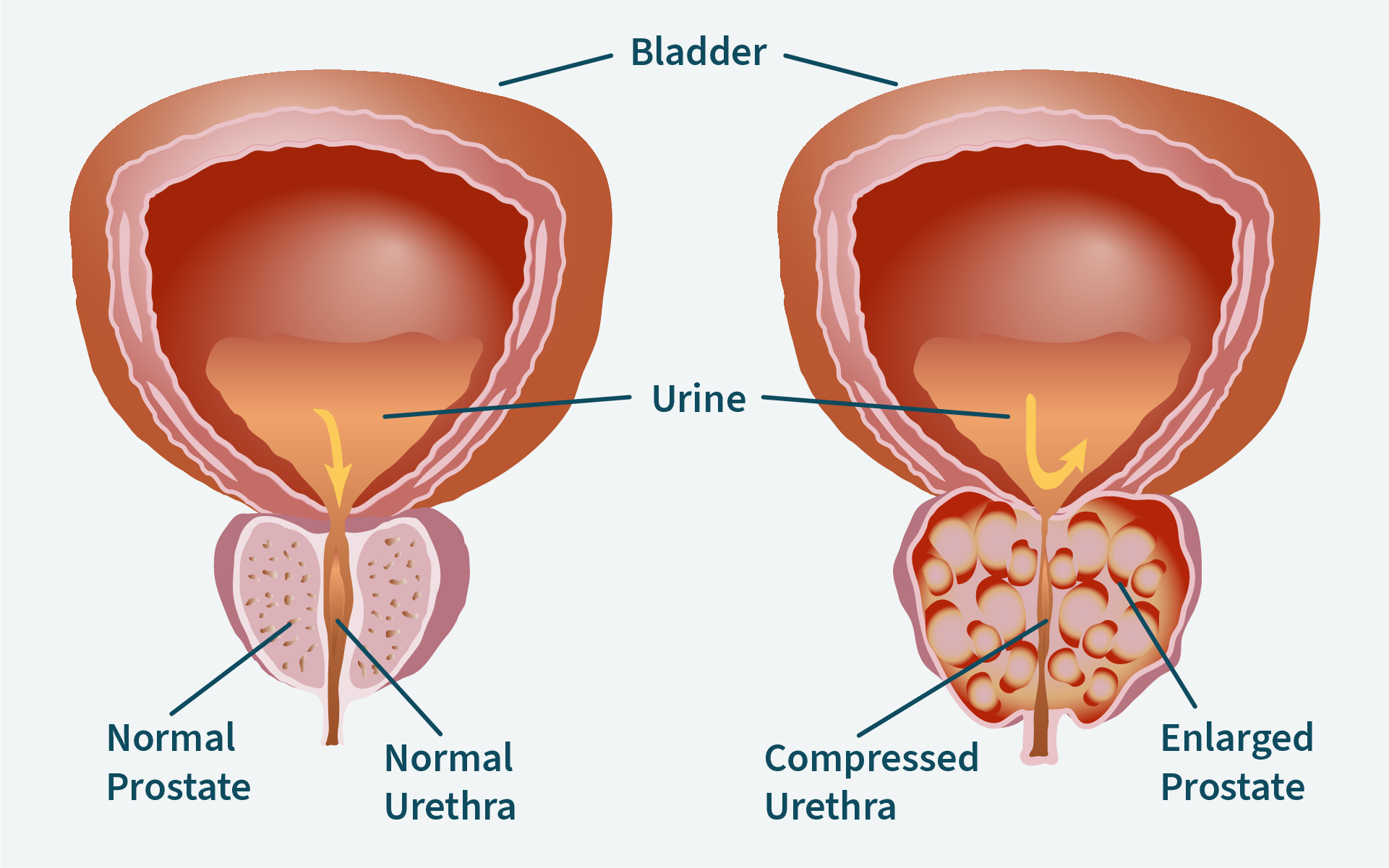 bpc-157 and enlarged prostate Trouble Urinating: Is My Prostate Enlarged?