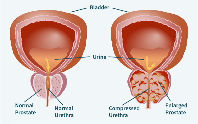 Trouble Urinating: Is My Prostate Enlarged? Trouble Urinating: Is My Prostate Enlarged?