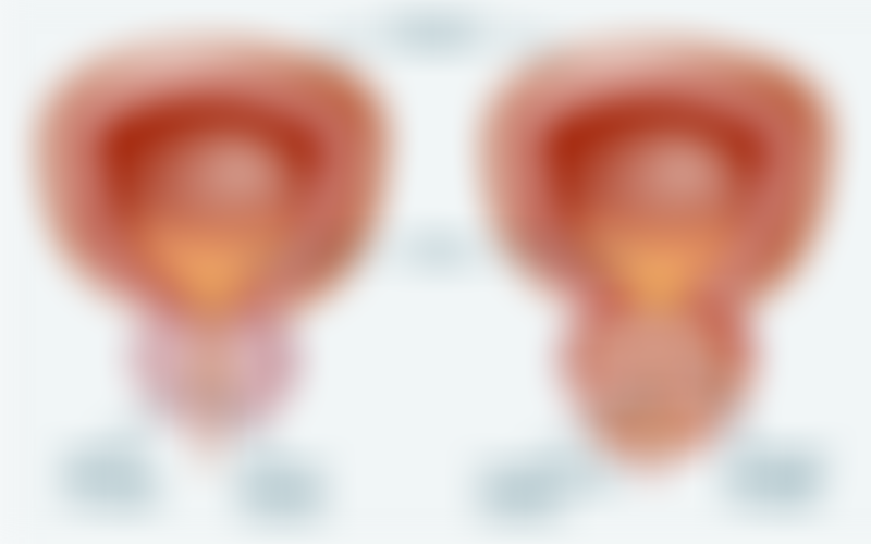Benign Prostatic Hyperplasia
