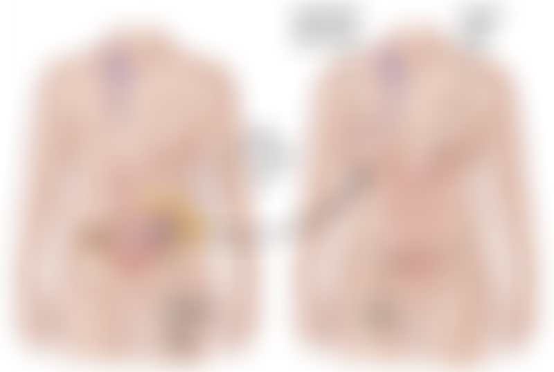 Breast Flap Reconstruction DIEP